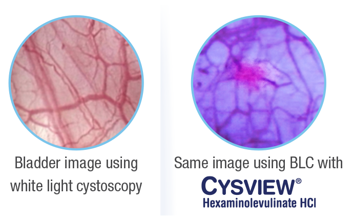 Left Image: Bladder image using white light cystoscopy / Right Image: Same image using BLC with Cysview.